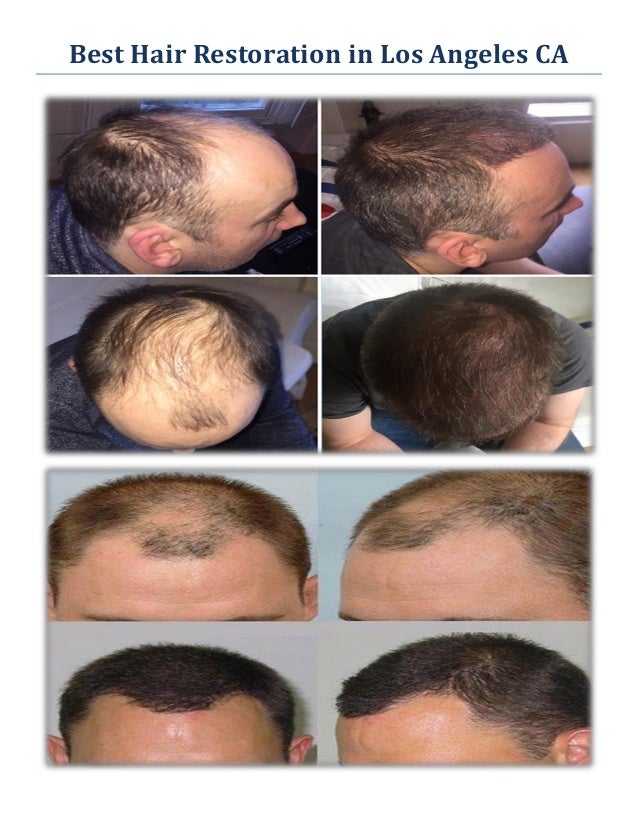 Best Hair Restoration : Hair Transplant Los Angeles CA