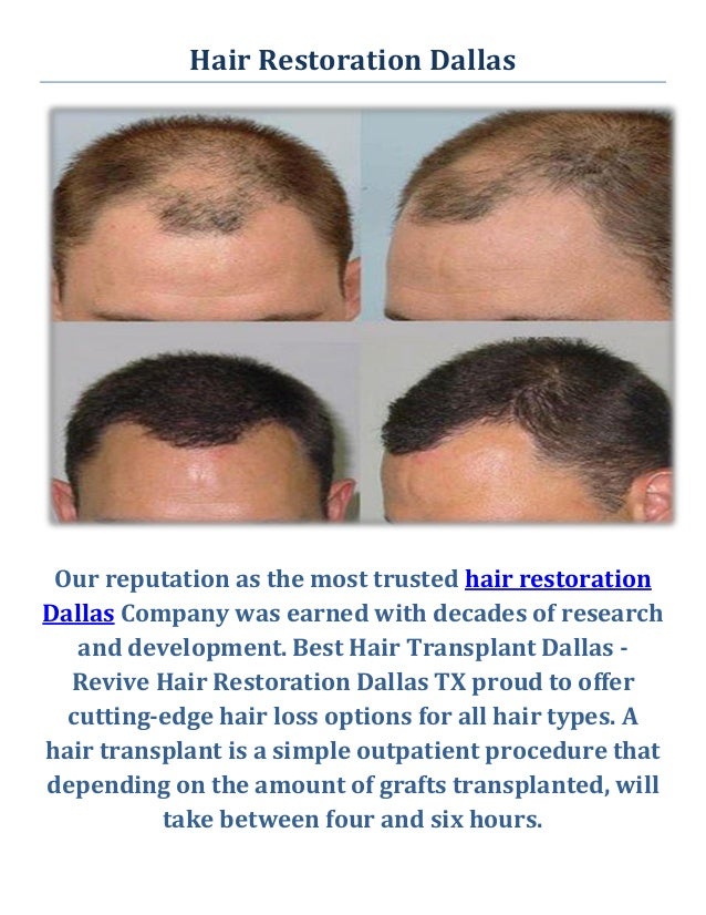 Best Hair Transplant Dallas Revive Hair Restoration in Dallas