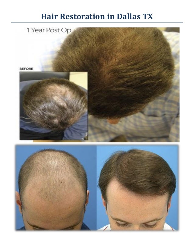 Best hair replacement options