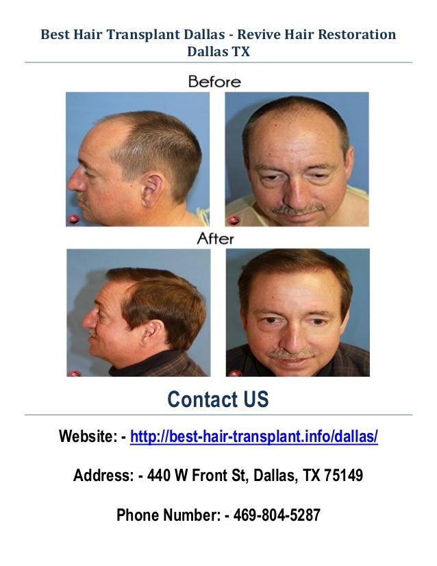 Best Hair Transplant Dallas Revive Hair Restoration in Dallas