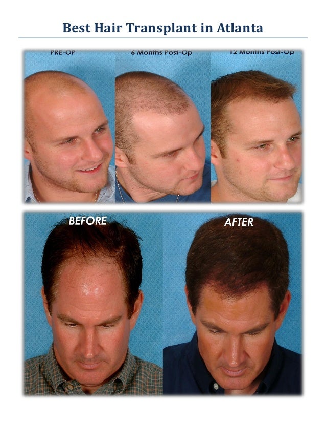 Best Hair Transplant in Atlanta GA Revive Hair Restoration