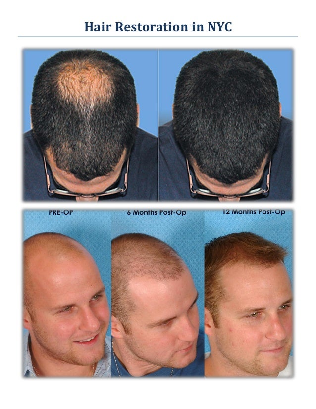 Neograft Hair Transplant Nyc Fue Hair Restoration In | best hair transplant nyc revive fue hair restoration in Neograft Hair Transplant Nyc Fue Hair Restoration In | best hair transplant nyc revive fue hair restoration in