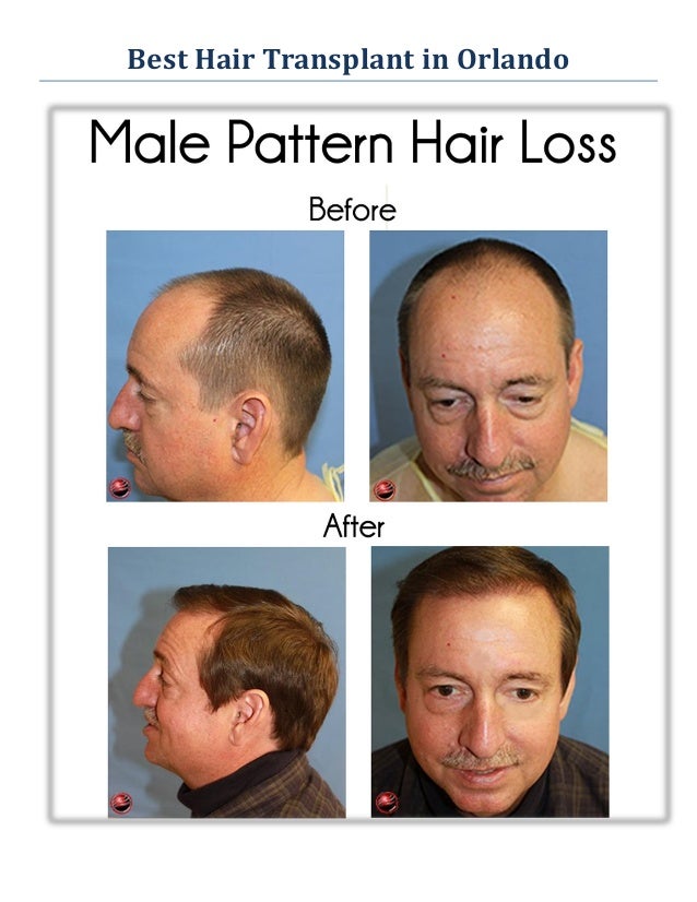 Best Hair Transplant Orlando Revive Hair Restoration in Orlando