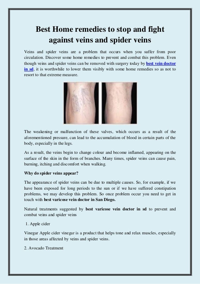 how to treat spider veins at home how to treat spider veins at home