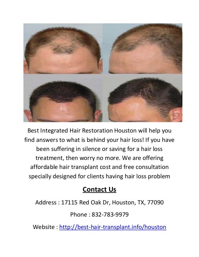 Best Integrated Hair Restoration In Houston Tx