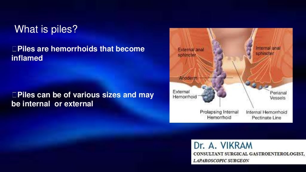 Best Piles Treatment in Chennai