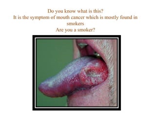 Do you know what is this?It is the symptom of mouth cancer which is mostly found in smokersAre you a smoker? 