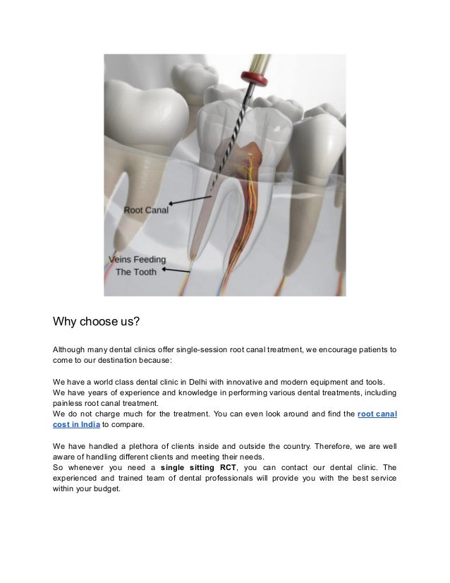 Best RCT Treatment In Delhi Single Sitting RCT