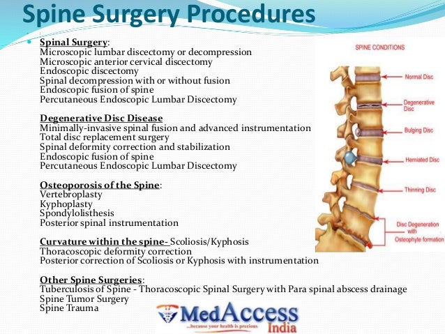 Best spine surgery hospital in india. Best spine surgery hospital in india.