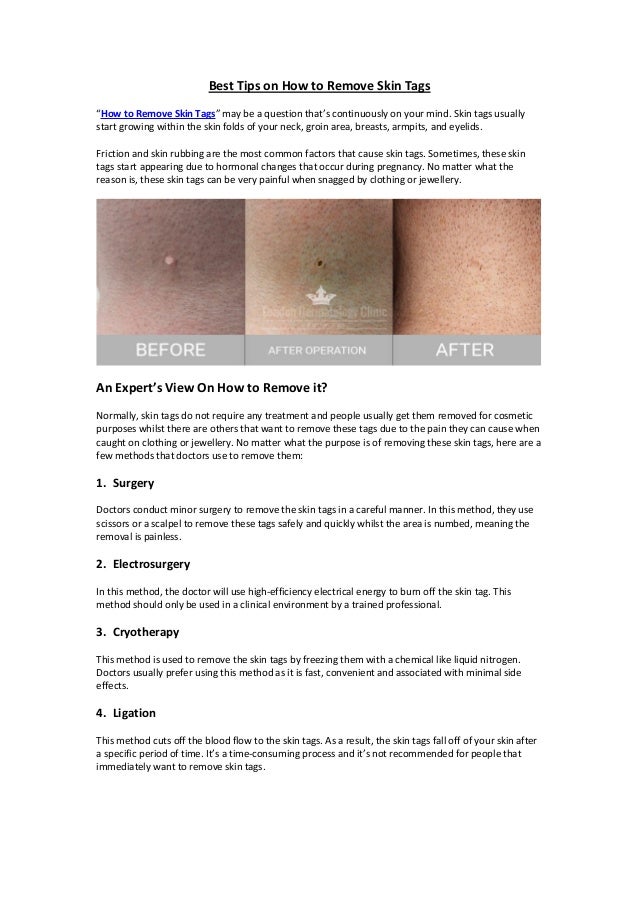 Best Tips On How To Remove Skin Tags