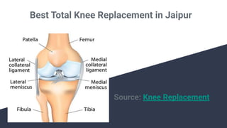 Best Total Knee Replacement in Jaipur
Source: Knee Replacement
 