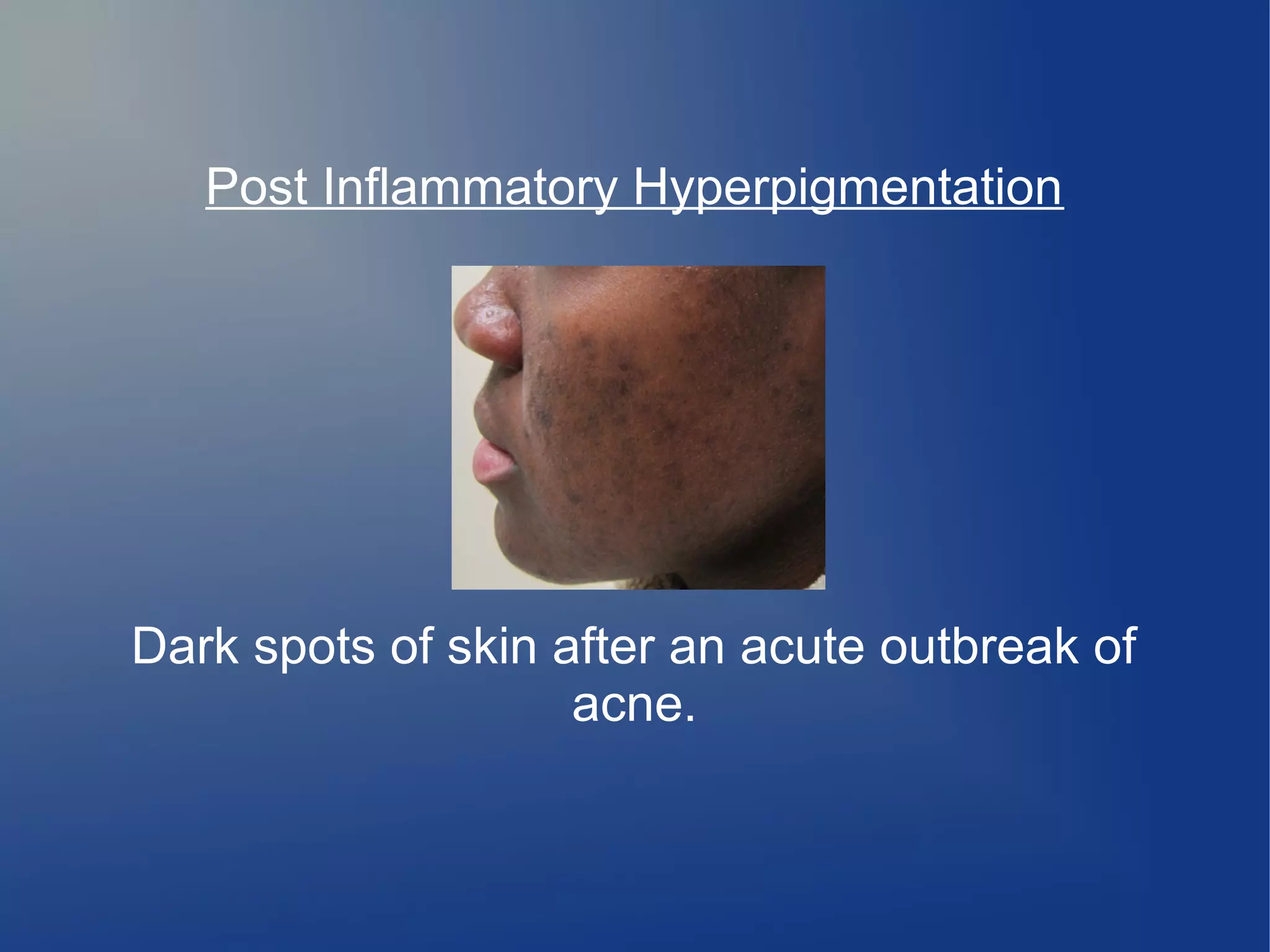 Post Inflammatory Hyperpigmentation

Dark spots of skin after an acute outbreak of
acne.

 
