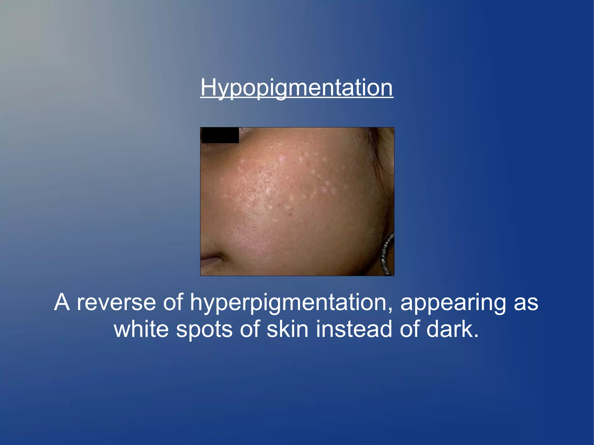 Hypopigmentation

A reverse of hyperpigmentation, appearing as
white spots of skin instead of dark.

 