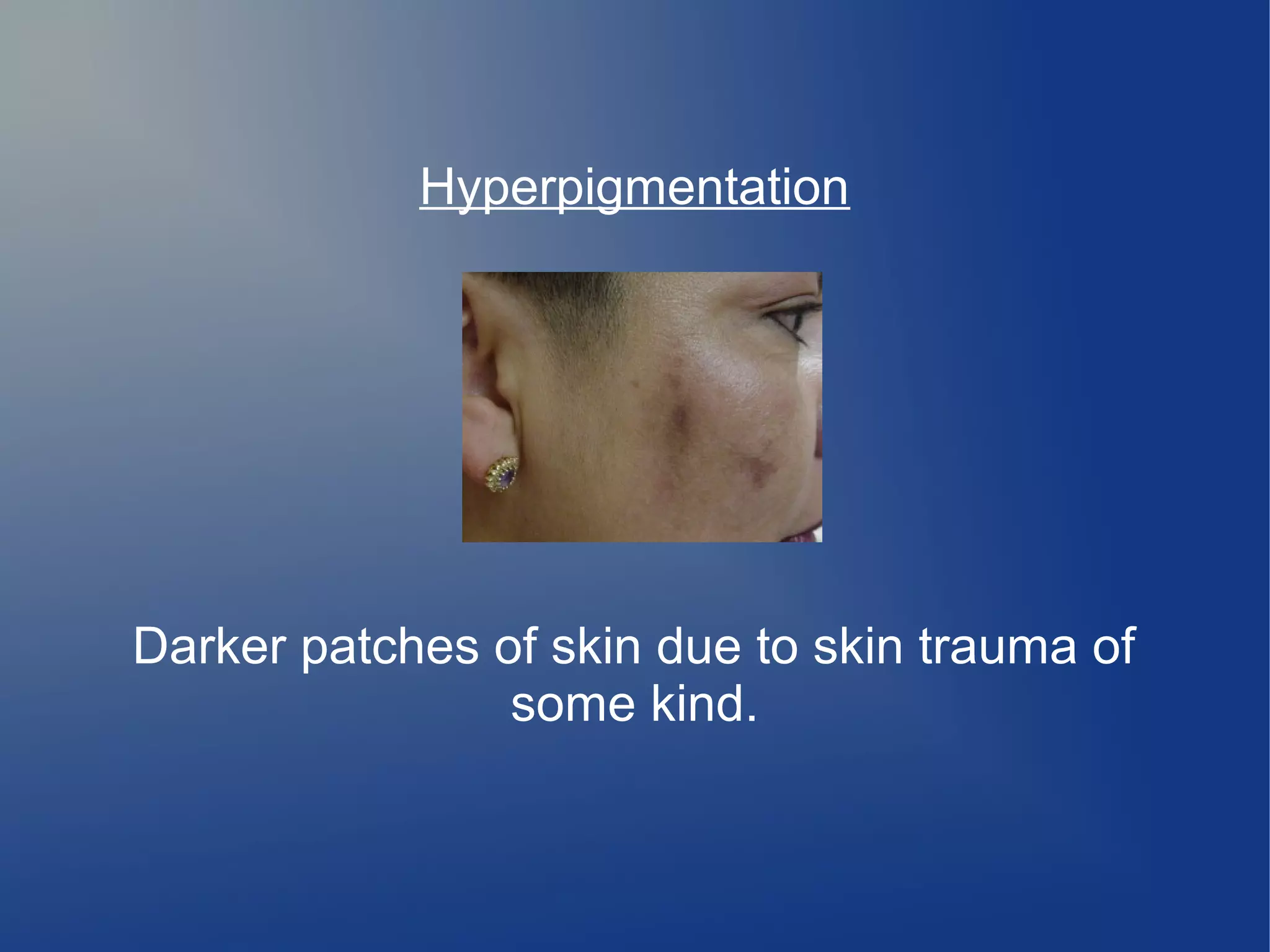 Hyperpigmentation

Darker patches of skin due to skin trauma of
some kind.

 