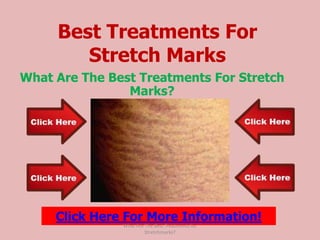 Best Treatments For
        Stretch Marks
What Are The Best Treatments For Stretch
                Marks?




     Click Here For More Information!
               What Are The Best Treatments for
                        Stretchmarks?
 