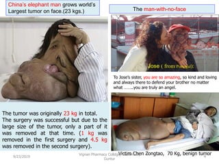 China’s elephant man grows world’s
Largest tumor on face.(23 kgs.) The man-with-no-face
The tumor was originally 23 kg in total.
The surgery was successful but due to the
large size of the tumor, only a part of it
was removed at that time. (1 kg was
removed in the first surgery and 4.5 kg
was removed in the second surgery).
Victim Chen Zongtao, 70 Kg, benign tumor
To Jose’s sister, you are so amazing, so kind and loving
and always there to defend your brother no matter
what ……..you are truly an angel.
9/23/2019 4
Vignan Pharmacy Colldge, Vadlamudi,
Guntur
Jose ( from Portugal):
 