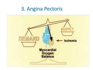 3. Angina Pectoris
 