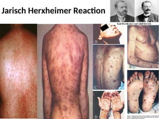 Jarisch Herxheimer Reaction
 