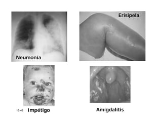 Erisipela
Neumonía
Impétigo Amigdalitis15:46
 