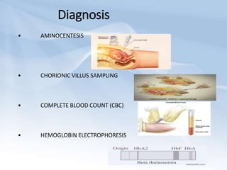 Diagnosis
• AMINOCENTESIS
• CHORIONIC VILLUS SAMPLING
• COMPLETE BLOOD COUNT (CBC)
• HEMOGLOBIN ELECTROPHORESIS
 
