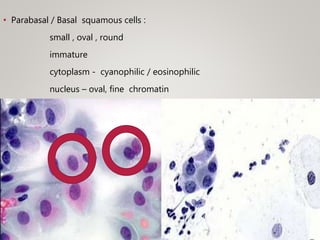 • Parabasal / Basal squamous cells :
small , oval , round
immature
cytoplasm - cyanophilic / eosinophilic
nucleus – oval, fine chromatin
 