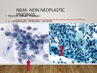 NILM- NON NEOPLASTIC
FINDINGS• Reactive cellular changes :
• 2. Lymphocytic (Follicular) cervicitis:
 