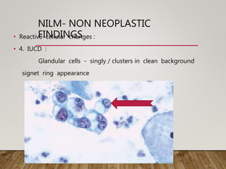 NILM- NON NEOPLASTIC
FINDINGS• Reactive cellular changes :
• 4. IUCD :
Glandular cells - singly / clusters in clean background
signet ring appearance
 