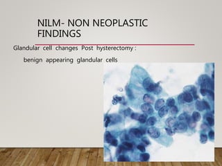 NILM- NON NEOPLASTIC
FINDINGS
Glandular cell changes Post hysterectomy :
benign appearing glandular cells
 