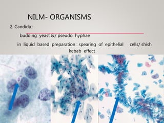 NILM- ORGANISMS
2. Candida :
budding yeast &/ pseudo hyphae
in liquid based preparation : spearing of epithelial cells/ shish
kebab effect
 