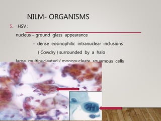 NILM- ORGANISMS
5. HSV :
nucleus – ground glass appearance
- dense eosinophilic intranuclear inclusions
( Cowdry ) surrounded by a halo
large multinucleated / mononucleate squamous cells
 