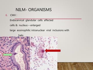 NILM- ORGANISMS
6. CMV :
Endocervical glandular cells affected
cells & nucleus – enlarged
large eosinophilic intranuclear viral inclusions with
halo
 