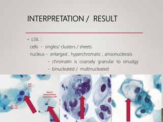 INTERPRETATION / RESULT
• LSIL :
cells - singles/ clusters / sheets
nucleus - enlarged , hyperchromatic , anisonucleosis
- chromatin is coarsely granular to smudgy
- binucleated / multinucleated
koilocytes & increased keratinization
 