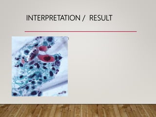 INTERPRETATION / RESULT
• HSIL with invasion
 