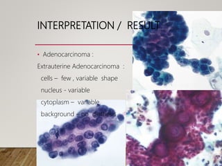 INTERPRETATION / RESULT
• Adenocarcinoma :
Extrauterine Adenocarcinoma :
cells – few , variable shape
nucleus - variable
cytoplasm – variable
background – no diathesis
 