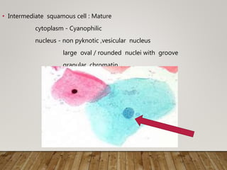 • Intermediate squamous cell : Mature
cytoplasm - Cyanophilic
nucleus - non pyknotic ,vesicular nucleus
large oval / rounded nuclei with groove
granular chromatin
 