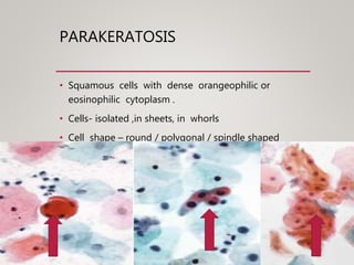 PARAKERATOSIS
• Squamous cells with dense orangeophilic or
eosinophilic cytoplasm .
• Cells- isolated ,in sheets, in whorls
• Cell shape – round / polygonal / spindle shaped
• Nucleus - pyknotic
 