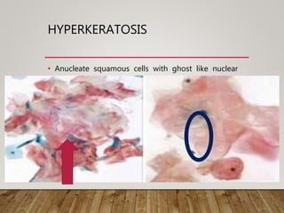 HYPERKERATOSIS
• Anucleate squamous cells with ghost like nuclear
holes .
 
