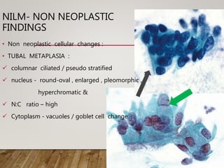 NILM- NON NEOPLASTIC
FINDINGS
• Non neoplastic cellular changes :
• TUBAL METAPLASIA :
 columnar ciliated / pseudo stratified
 nucleus - round-oval , enlarged , pleomorphic ,
hyperchromatic &
 N:C ratio – high
 Cytoplasm - vacuoles / goblet cell change
 