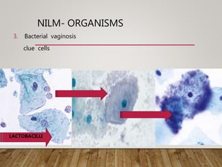 NILM- ORGANISMS
3. Bacterial vaginosis
clue cells
LACTOBACILLI
 