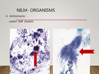 NILM- ORGANISMS
4. Actinomyces :
cotton ball clusters
 