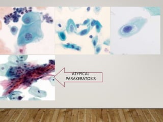 ATYPICAL
PARAKERATOSIS
 