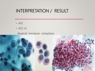 INTERPRETATION / RESULT
• ASC
• ASC-H:
Atypical immature metaplasia
Crowded sheet pattern
 