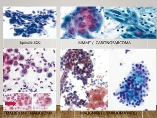 Spindle SCC MMMT / CARCINOSARCOMA
MALIGNANT MALANOMA MALIGNANT LYMPHOMA (NHL)
 