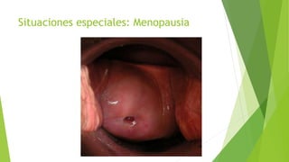 Situaciones especiales: Menopausia
 