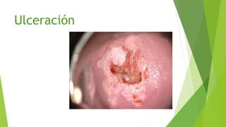 Ulceración
 