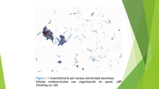 Figura 1.1 Insatisfactorio por escasa celularidad escamosa.
Células endocervicales con organización en panal. LBP
ThinPrep en 10X
 