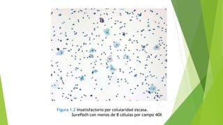 Figura 1.2 Insatisfactorio por celularidad escasa.
SurePath con menos de 8 células por campo 40X
 