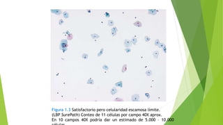 Figura 1.3 Satisfactorio pero celularidad escamosa límite.
(LBP SurePath) Conteo de 11 células por campo 40X aprox.
En 10 campos 40X podría dar un estimado de 5.000 – 10.000
 