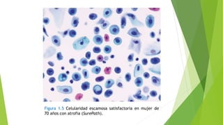 Figura 1.5 Celularidad escamosa satisfactoria en mujer de
70 años con atrofia (SurePath).
 