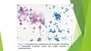 Figura 1.6 Procesamiento insatisfactorio de la muestra (ThinPrep).
a. Celularidad escamosa escasa por sangre excesiva y b.
reprocesamiento
 